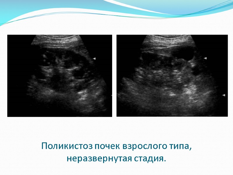 Поликистоз почек взрослого типа, неразвернутая стадия.